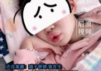 8歲女孩吃布洛芬過敏腫成香腸嘴 目前孩子無礙