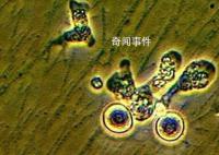 韓國報告首例“食腦蟲”病例 從泰國回國后死亡