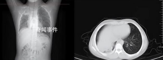 男孩咳嗽發(fā)熱在家硬扛成白肺 目前的癥狀已經明顯好轉
