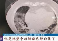 白肺是否會對肺部造成不可逆?zhèn)?這些人做個(gè)CT很有必要