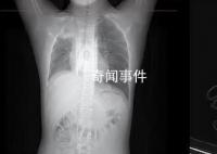 男孩咳嗽發(fā)熱在家硬扛成白肺 目前的癥狀已經(jīng)明顯好轉(zhuǎn)