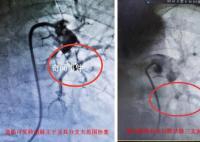 陽性一個月后肺栓塞風險增加33倍 一醫生接連搶救兩名患者都出現了胸悶胸痛癥狀