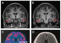 醫(yī)生發(fā)現(xiàn)19歲阿爾茲海默癥患者 一度不敢相信檢查結(jié)果