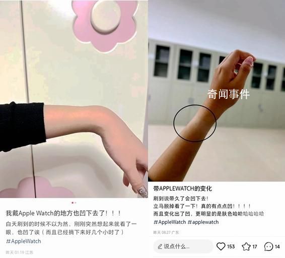 多人稱戴蘋果手表"手凹了" 相關部位出現疼痛癥狀