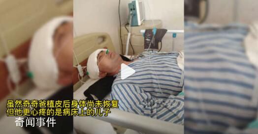 爸爸先后三次取頭皮救重傷兒子 玩酒精兄弟倆被燒傷