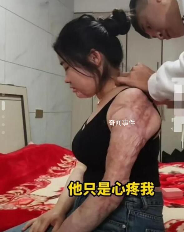 女子回應燒傷后被男友照顧6年 表示很感謝男友的付出