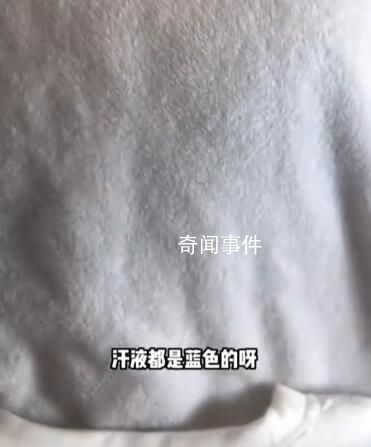 女孩出汗把衣服染藍查出色汗癥 色汗癥色汗癥對身體什么危害
