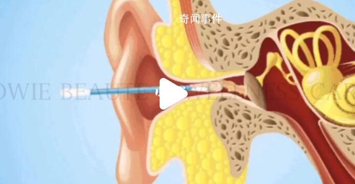 為什么不建議自己掏耳朵 為什么需要專業采耳師進行采耳