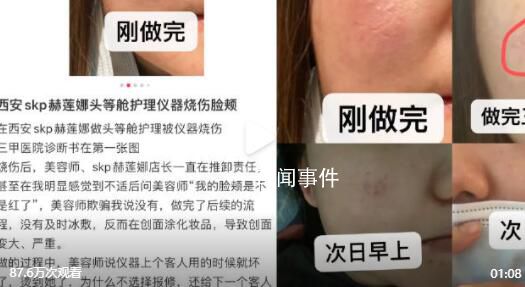 網友曝在赫蓮娜做護理致臉部燒傷 因儀器有損壞和美容師操作不當
