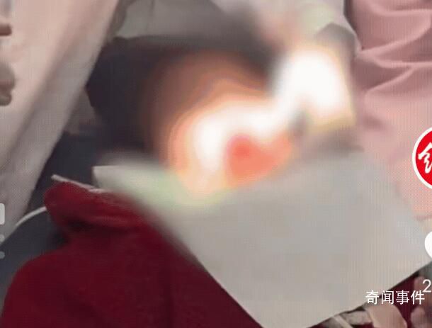 醫生誤判將女孩恒牙當乳牙拔掉 家屬索賠12萬