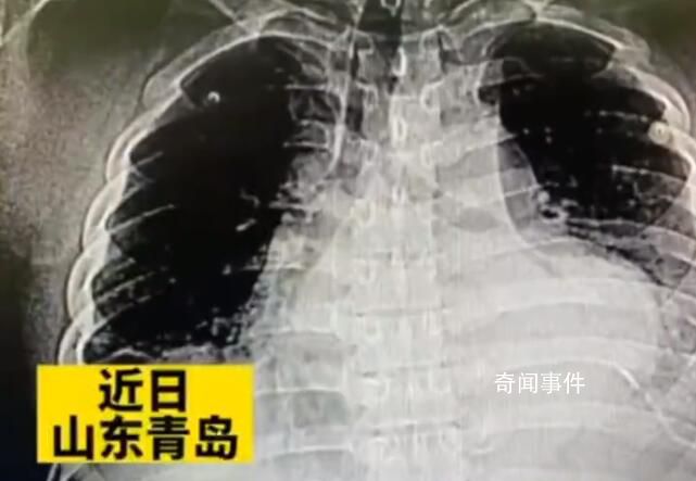 男子頭疼自己在家針灸扎破心臟 目前患者生命體征穩定