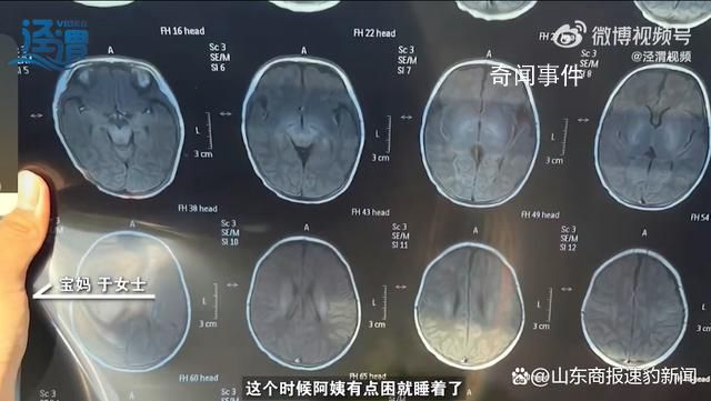 月嫂拍嗝時(shí)打盹致嬰兒頭頂骨骨折 治療后醫(yī)生建議半年內(nèi)觀察情況并復(fù)查