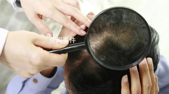 韓政府將向年輕脫發患者提供補貼 在韓國引發爭議