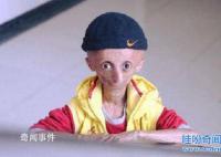 揭秘未老先衰男童未解之謎 未老先衰是一種怎樣的狀態(tài)