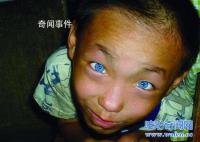 廣西貓眼男孩之謎 廣西貓眼男孩還活著嗎