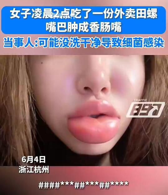 女生半夜嗦田螺腫成香腸嘴 吃了兩天的消炎藥目前已經消腫了