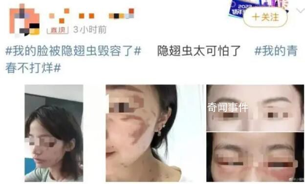 隱翅蟲的毒液堪比硫酸 隱翅蟲咬后皮膚潰爛幾天能夠好