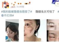 隱翅蟲的毒液堪比硫酸 隱翅蟲咬后皮膚潰爛幾天能夠好