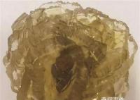 臺州女子身體里取出了“花” 長得像玫瑰一樣的結石你見過嗎?