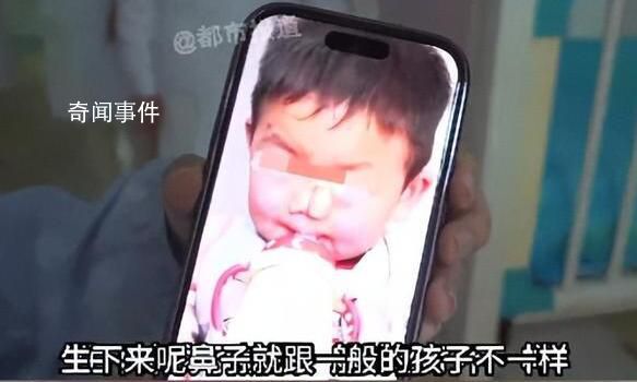 3歲男孩患象鼻病全球僅34例 象鼻病是什么病