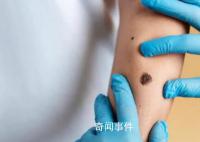 如何分辨黑色素瘤和普通痣?