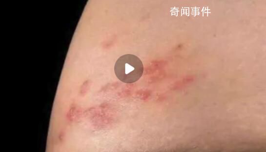 新冠后得帶狀皰疹的人變多了?