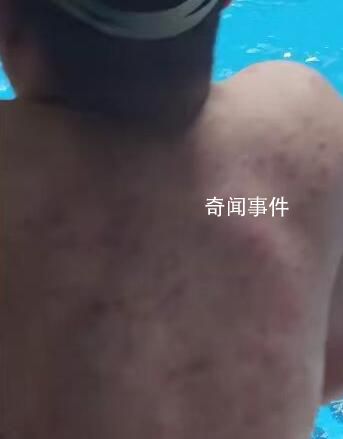 女子吐槽男子滿背疙瘩進泳池游泳 令人毛骨悚然