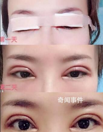 女子不滿意雙眼皮手術 要求槍斃醫生