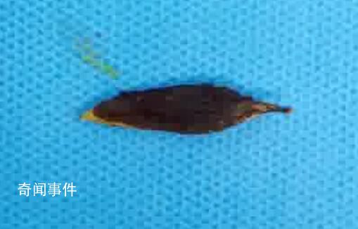 男子吃粽子誤吞棗核致小腸穿孔 醫(yī)院已收治不少誤吞棗核的患者
