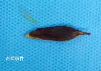 男子吃粽子誤吞棗核致小腸穿孔 醫院已收治不少誤吞棗核的患者