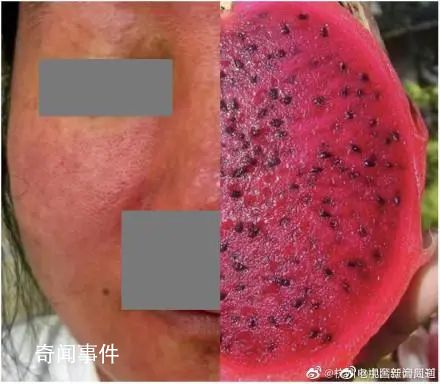 杭州女子養(yǎng)倉(cāng)鼠臉爛成火龍果 全身布滿紅斑
