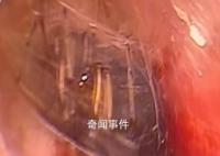 蜘蛛在男子睡夢時鉆入耳道結網 網友：看著就疼