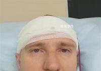 男子為控制夢境給腦袋鉆孔 失血近1升險些喪命