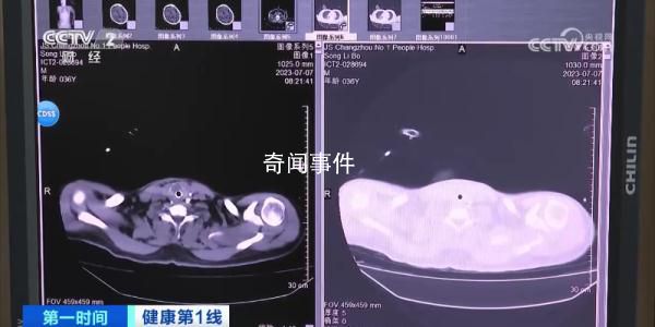 36歲男子吹空調住進ICU 如何預防空調病