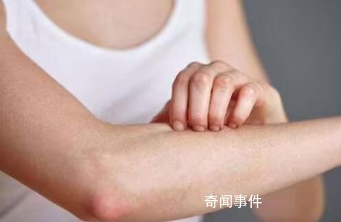 過敏多發 “元兇”就在身邊 低齡患者明顯增多