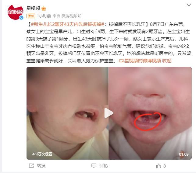 早產兒出生罕見長2顆牙先后被拔掉 拔掉后不再長乳牙