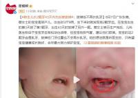 早產兒出生罕見長2顆牙先后被拔掉 拔掉后不再長乳牙