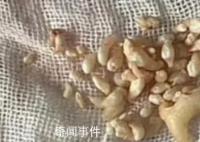 拔掉57顆牙是什么體驗 牙瘤是什么病嚴重嗎