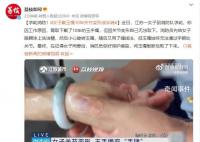 女子戴玉鐲10年關節(jié)變形成手銬 玉鐲始終無法通過手腕處關節(jié)