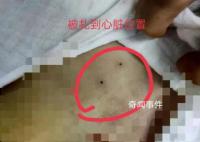 醫院回應穿刺失誤致女童死亡 正在走司法途徑