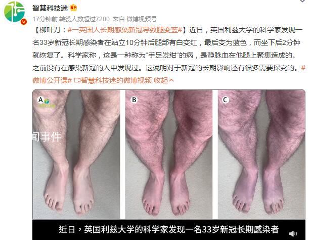 一英國(guó)人長(zhǎng)期感染新冠導(dǎo)致腿變藍(lán) 坐下后2分鐘就恢復(fù)了