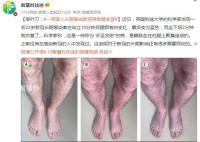 一英國(guó)人長(zhǎng)期感染新冠導(dǎo)致腿變藍(lán) 坐下后2分鐘就恢復(fù)了
