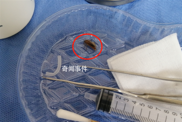 男子半夜臥床玩手機蟑螂鉆進耳朵 傳來一陣劇烈的疼痛