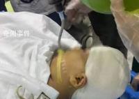 被老師打傷女孩頭部水腫有感染風險 引發了網友們的關注