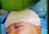被打破頭骨女生已清醒?家屬回應(yīng)