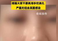 女生稱因愛摳鼻子致鼻內長多團真菌 ：希望大家不要再挖鼻孔
