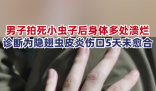 男子拍死隱翅蟲多處潰爛5天未愈 目前傷口仍未愈合