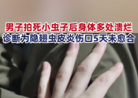 男子拍死隱翅蟲多處潰爛5天未愈 目前傷口仍未愈合