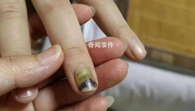 19歲女子被騙緬甸獲救時遍體鱗傷 目前正接受身體以及精神方面的治療