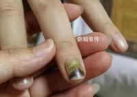 19歲女子被騙緬甸獲救時遍體鱗傷 目前正接受身體以及精神方面的治療